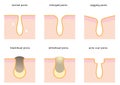 Set of skin pores: normal, sagging, enlarged, blackhead, whitehead and acne scar Royalty Free Stock Photo