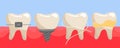 A set of teeth on the gums with braces, a false tooth, clean with dental floss, with tartar and plaque. The teeth are Royalty Free Stock Photo