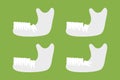 Set of type of wisdom tooth with mandible or lower jaw