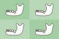 Set of type of wisdom tooth in mandible or lower jaw