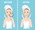 Before-After set of upset and happy woman with female facial skin problems needs to care about: acne, pimples. Royalty Free Stock Photo