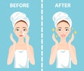 Before-After set of upset and happy woman with female facial skin problems needs to care about: blackheads, clogged nose Royalty Free Stock Photo