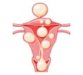 Set of Uterine fibroids Female leiomyomas reproductive system uterus in different styles and cross sections. Front view Royalty Free Stock Photo
