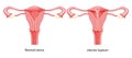 Set of Uterine septum septate uterus normal and with disease Female reproductive system diagram. Front view