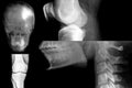 Set of x-ray body parts such as human knee, head, jaw and teeth, group of x-ray images for diagnosing different types of Royalty Free Stock Photo