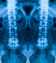 Set of X-ray of the bones of the human lower lumbar part of the vertebral column