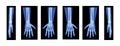 Set of X-Ray Hands with Radius, Ulna Skeleton Human body, Bones adult people roentgen front back side view. 3D realistic