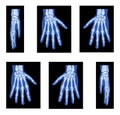 Set of X-Ray Hands Skeleton Human body, Bones adult people roentgen front back side view. 3D realistic flat blue color