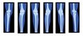 Set of X-Ray Knee femur leg Skeleton Human body - Patella, epicondyle, Tibia, Fibula Bones adult people roentgen front