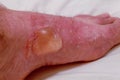 Severe burn and blister on legs, close-up