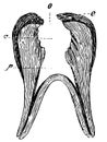 Severe form of tooth decay. Teeth becoming hollow.