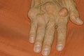 Severe gout in men suffering from joint pain, bone pain, gout, rheumatoid symptoms, radioactive sickness,