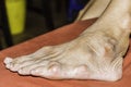 Severe gout in men suffering from joint pain, bone pain, gout, rheumatoid symptoms, radioactive sickness,