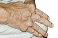 Severe gout in men suffering from joint pain, bone pain, gout, rheumatoid symptoms, radioactive sickness,