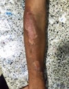 Severe niacin deficiency or pellagra or photosensitive dermatitis in right forearm of alcoholic adult patient