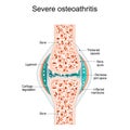 Severe osteoarthritis. Synovial joint