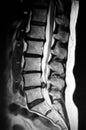 Severe pathology of lumbar spine herniation mri