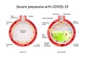 Severe pneumonia with COVID-19