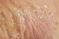 severe pustular psoriasis lesions on the sole of the foot Royalty Free Stock Photo