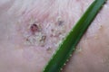 Severe pustular psoriasis lesions on the sole of the foot