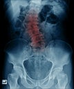 scoliosis lumbar x-ray image