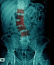 Severe scoliosis