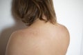 Severe skin damage from sun rays. Peeling skin on a man& x27;s back and shoulders due to sunburn. Royalty Free Stock Photo