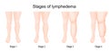 Severity of lower extremity lymphedema in different stages.