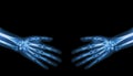 Shake hands . X-ray normal human hands ( blank area at upper side )