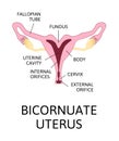 The shape of the uterus, the female reproductive organ. normal, mild arcuate, moderate, severe