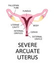 The shape of the uterus, the female reproductive organ. normal, mild arcuate, moderate, severe