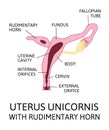 The shape of the uterus, the female reproductive organ. uterus unicornis Royalty Free Stock Photo