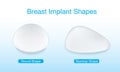 Shapes of breast implant