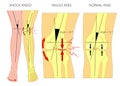 Shapes of the legs.Normal and curved legs.Knock knees.Bowed leg