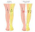 Shapes of the legs.Normal and curved legs.Knock knees.Bowed leg