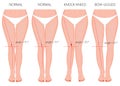 Shapes of the legs. Normal and curved legs. Knock knees. Bowed leg Royalty Free Stock Photo