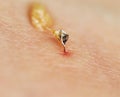 sharp bee sting painfully pierced the skin and injected the poison Royalty Free Stock Photo