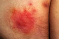 Shingles disease. Sympton of the Herpes virus on the human body. Skin rash and blisters on the body Royalty Free Stock Photo