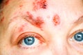 Shingles on the Face and Around the Eye, Called ophthalmic herpes zoster or herpes zoster ophthalmicus Royalty Free Stock Photo