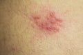 Shingles (herpes zoster) blister skin rash Royalty Free Stock Photo