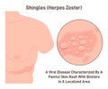 Shingles. Herpes zoster, viral disease with skin rush with stripe of blisters