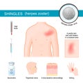 Shingles. infographics about symptoms of herpes zoster