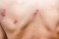 Shingles on men herpes zoster. Closeup.