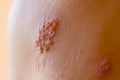 Shingles on men herpes zoster. Closeup. Royalty Free Stock Photo
