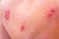 Shingles on men herpes zoster. Closeup. Royalty Free Stock Photo