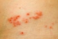 Shingles Rash Royalty Free Stock Photo