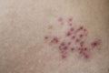 Shingles Rash Blisters on Man Skin