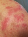 Shingles rash on shoulder day one of outbreak Royalty Free Stock Photo