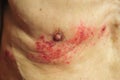 Shingles is a viral infection that causes a painful rash Royalty Free Stock Photo