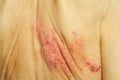 Shingles is a viral infection that causes a painful rash Royalty Free Stock Photo